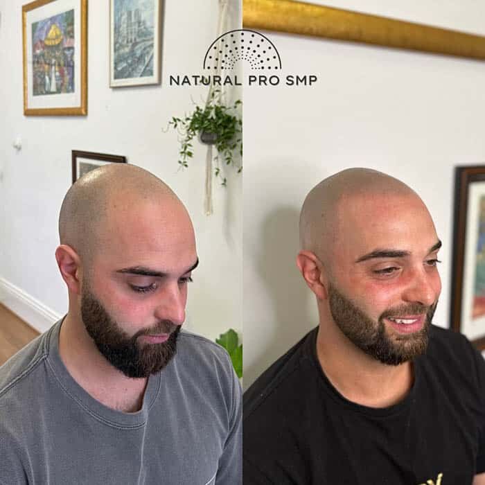 SMP-melbourne-natural-pro-smp-before-after-2024-002